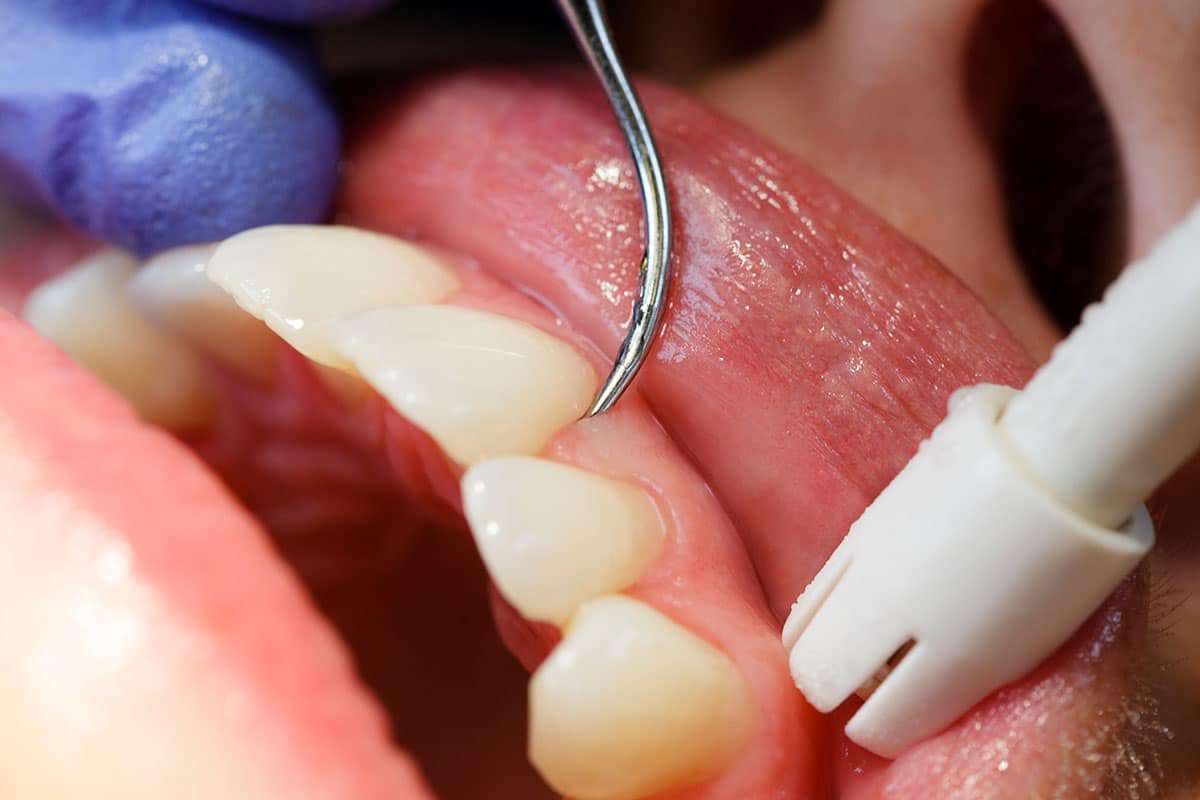 8 Factors That Increase Your Risk Of Developing Gum Disease Blog